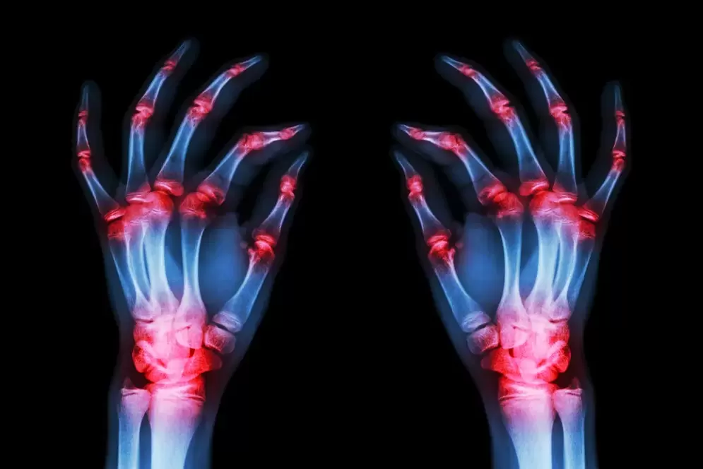 Osteoartrita articulațiilor degetelor