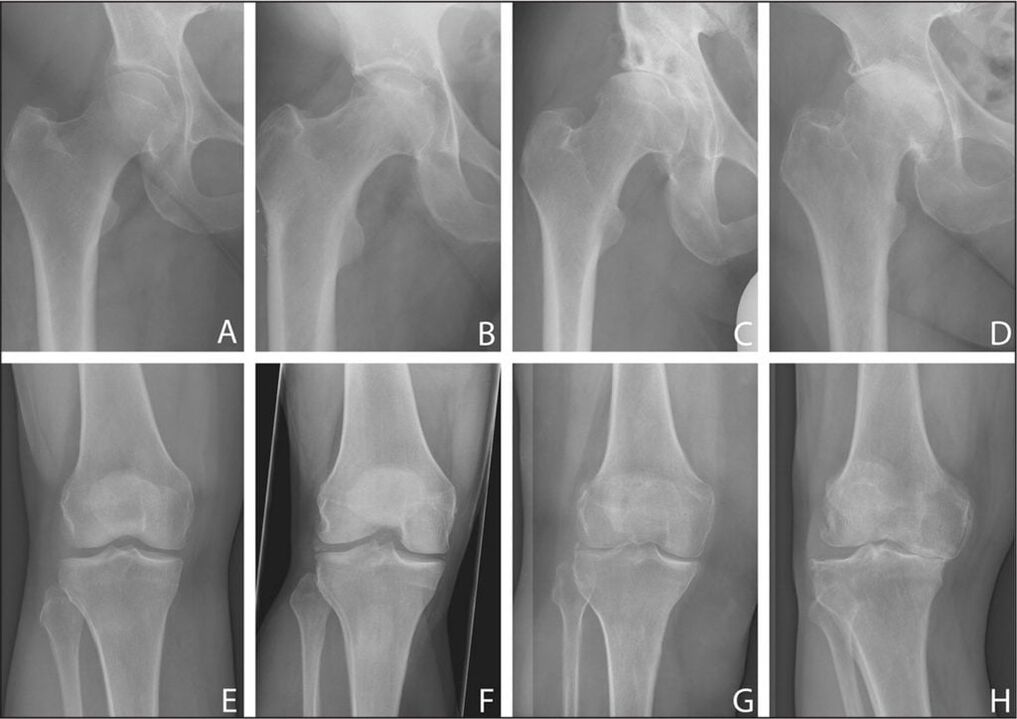 Osteoartrita articulației șoldului în dinamică