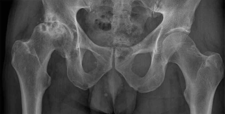 Stadiul 3 osteoartrita a articulației șoldului pe radiografie