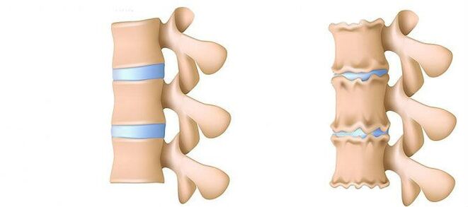 Osteochondroză din interior