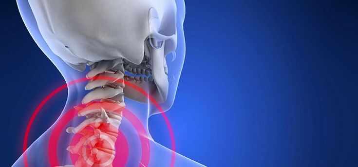 Osteochondroza regiunii colului uterin