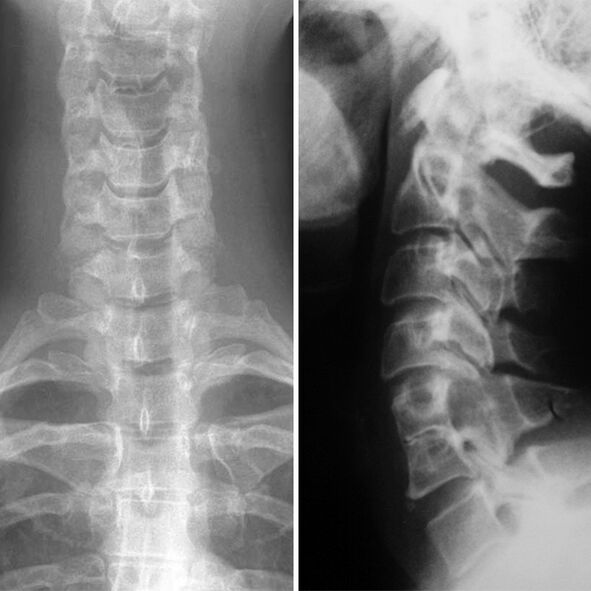 X -Ray the coloana cervicală