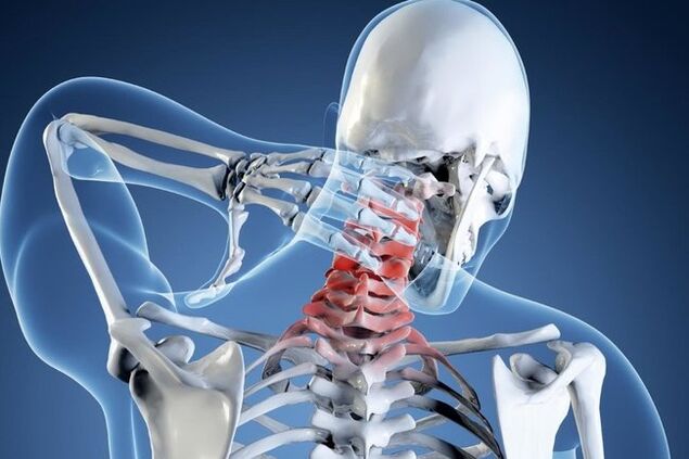 Osteochondroza regiunii colului uterin
