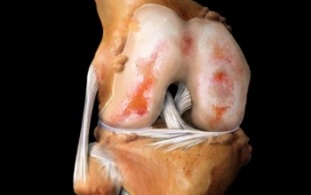 Ce este osteoartrita genunchiului