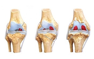 Etape ale osteoartritei articulației genunchiului