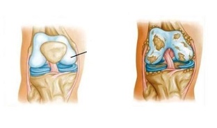 modificări patologice în osteoartrita genunchiului