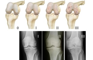 Metode de diagnosticare a osteoartritei genunchiului