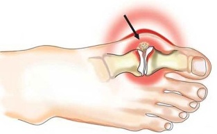 Inflamația articulației dintre degetul mare și picior în artrită