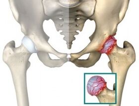 tratamentul articulațiilor șoldului etc făcând clic pe articulații duce la artrită