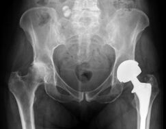 Diagnosticul osteoartritei articulației șoldului