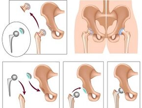 Endoproteză pentru osteoartrita articulației șoldului