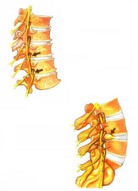 Ilustrația osteocondrozei coloanei vertebrale