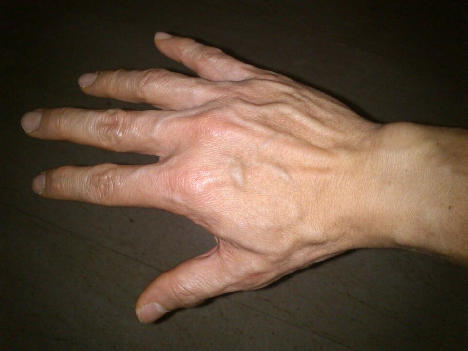 Deformare osoasa si durere la nivelul articulatiilor degetelor