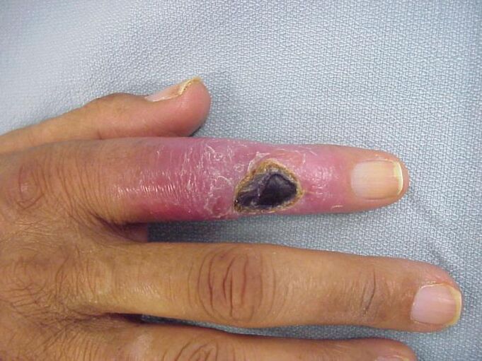 Osteomielita ca o cauză a durerii în articulațiile degetelor