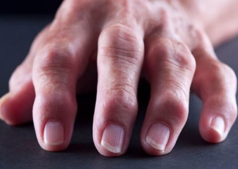 artrita reumatoidă ca cauză a durerii la nivelul articulațiilor degetelor