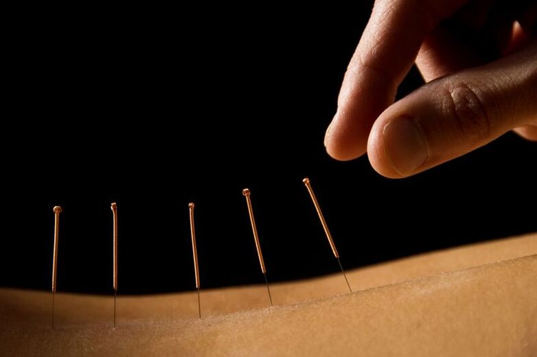 Acupunctura pentru durerile de spate