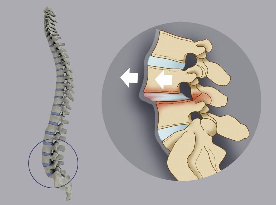 Deplasarea vertebrelor ca cauză a durerilor de spate