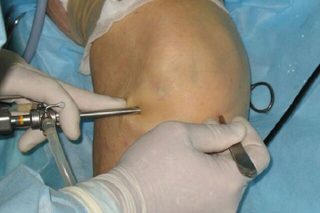 Artroscopia pentru dureri de genunchi